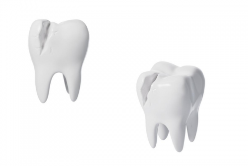 提升根管治疗成功率:全面解析牙根纵裂的预防与管理 提升根管治疗成功率:全面解析牙根纵裂的预防与管理