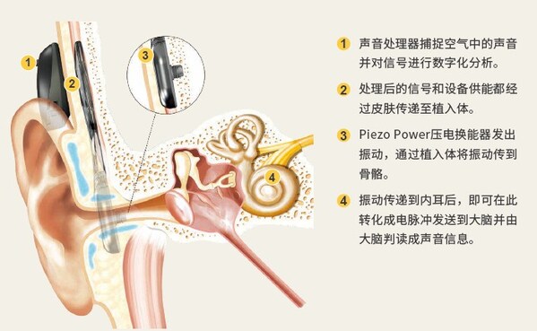 科利耳®澳晰亚™Osia™ 2系统中国大陆上市 科利耳®澳晰亚™Osia™ 2系统中国大陆上市